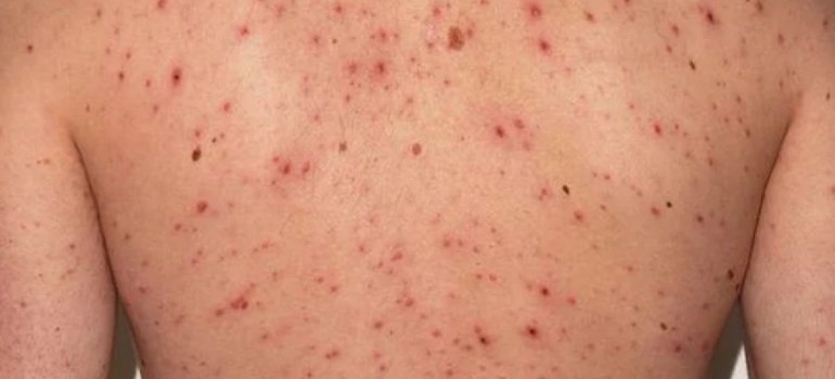 Primer caso de viruela del mono en Maq. Savio: un hombre de 38 años que evoluciona favorablemente en su domicilio (imagen ilustrativa)